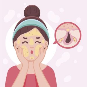 Do Microscópio ao Espelho As Diferentes Faces da Acne e Suas Implicações.
